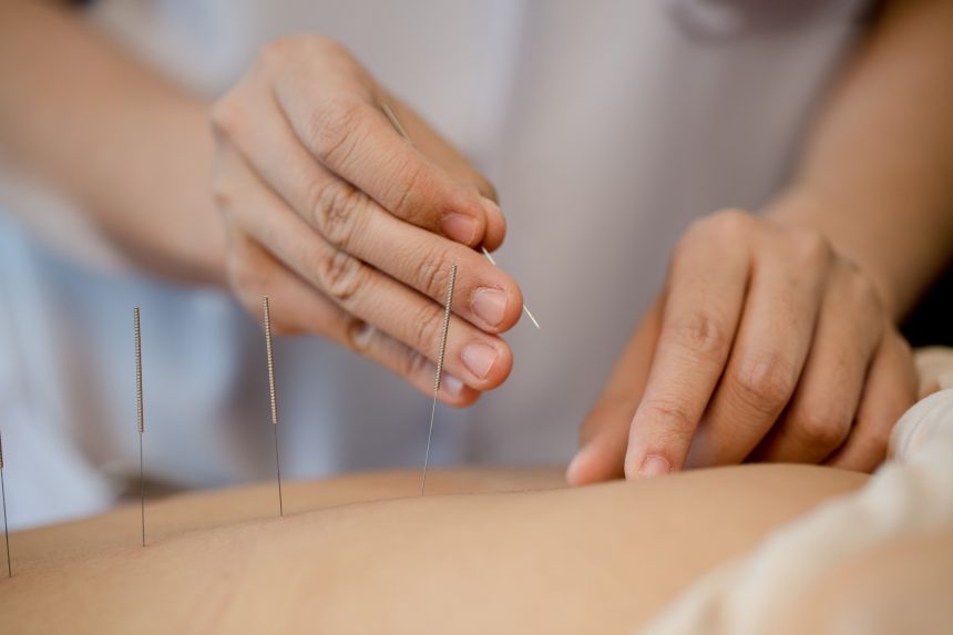 Você sabia que tem direito a sessões de acupuntura na Unimed? Conheça os benefícios